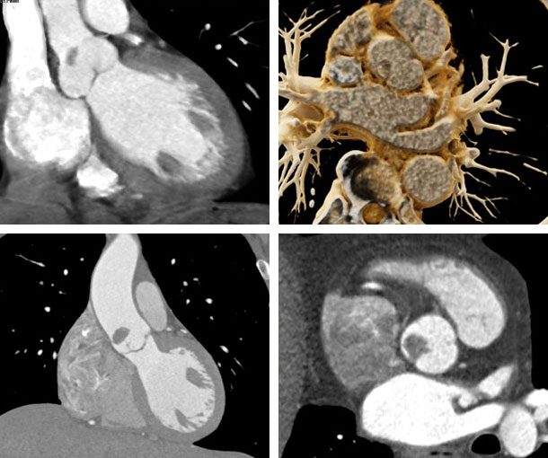 Papillary Fibroelastoma CT Findings
