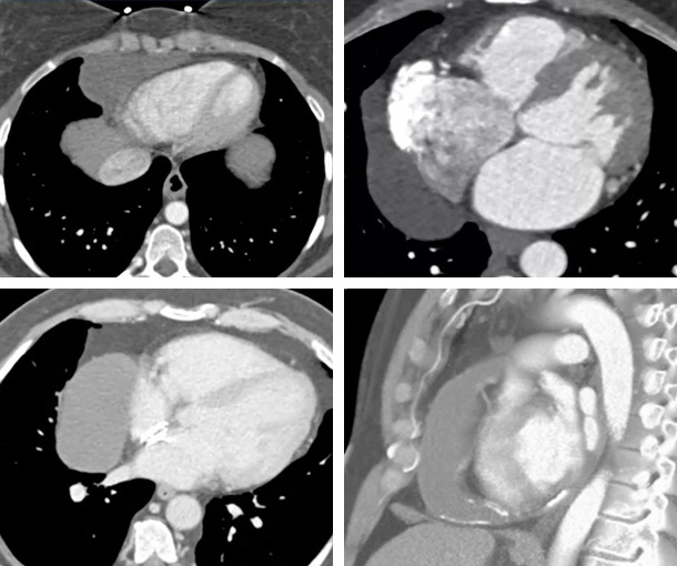 Pericardial Cyst CT Findings