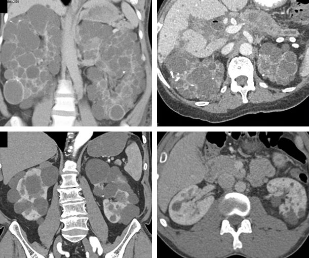 Polycystic Kidney Disease CT Findings
