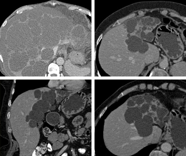 Polycystic Liver Disease CT Findings