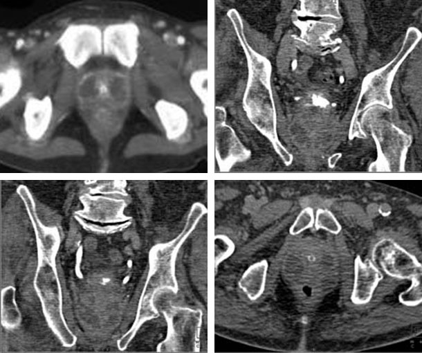 Prostatitis CT Findings