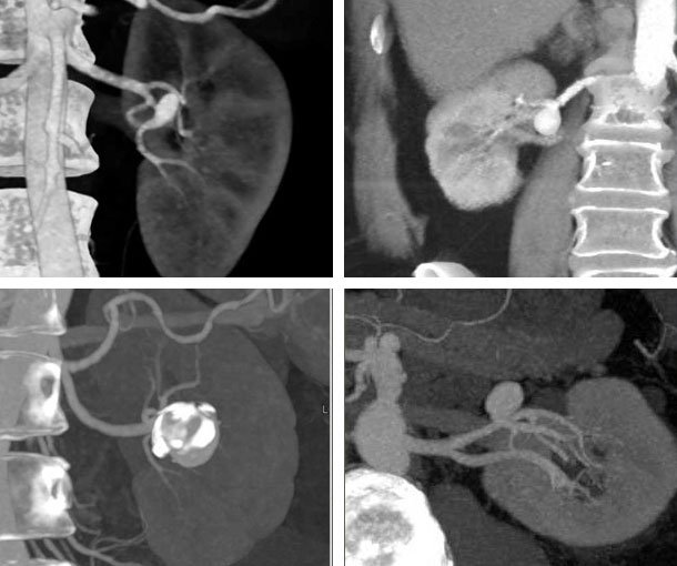 Renal Artery Aneurysm CT Findings