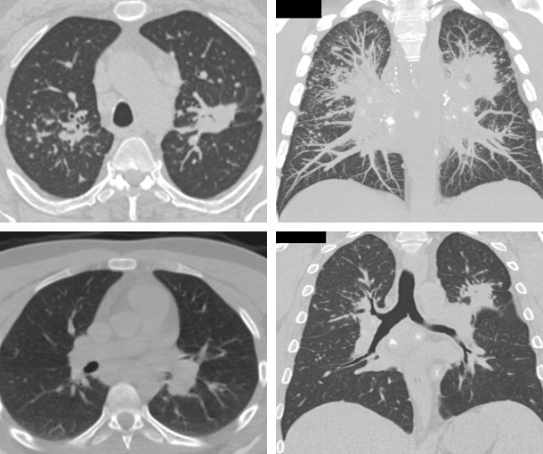 Sarcoidosis of the Lungs