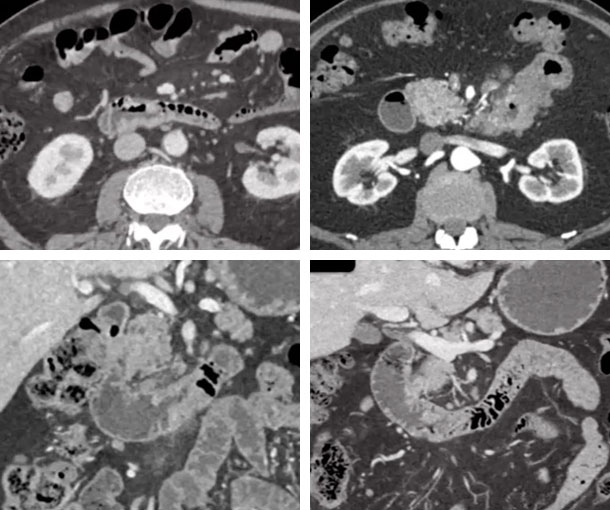 Small Bowel Adenocarcinoma CT Findings