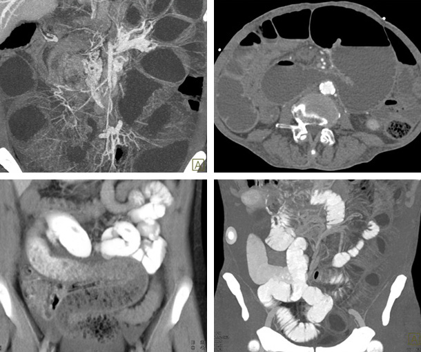 Small Bowel Obstruction CT Findings