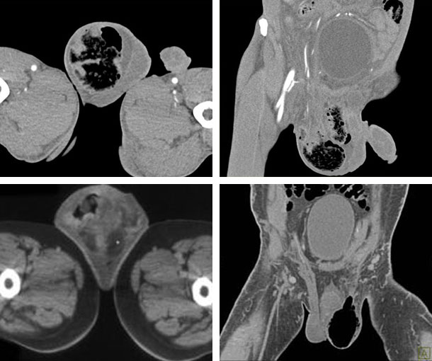 Scrotal Abscess CT Findings