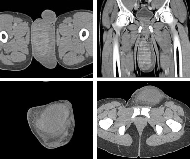 Scrotal Hematoma CT Findings