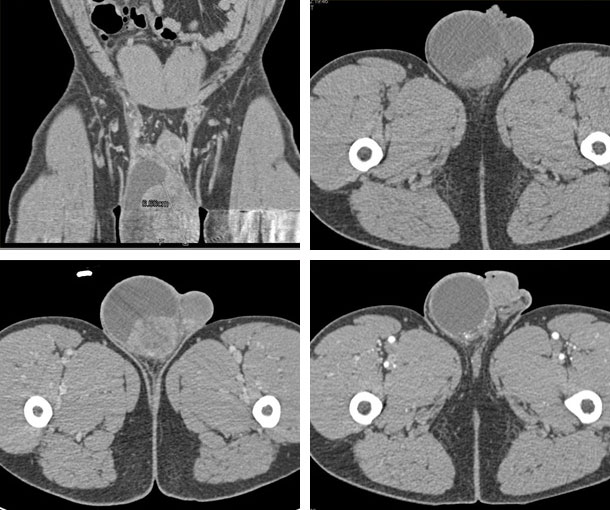 Seminoma CT Findings