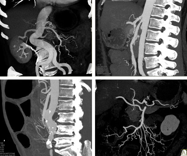 SMA Vasculitis CT Findings