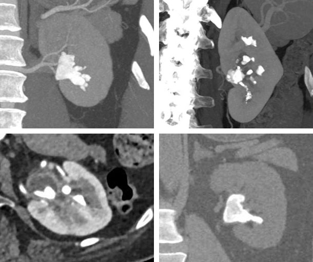 Staghorn Calculus CT Findings