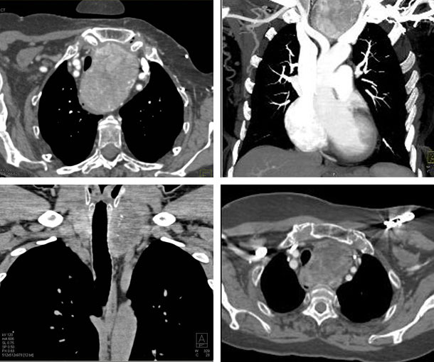 Substernal Goiter CT Findings