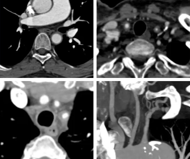 Takayasu's Aortitis CT Findings