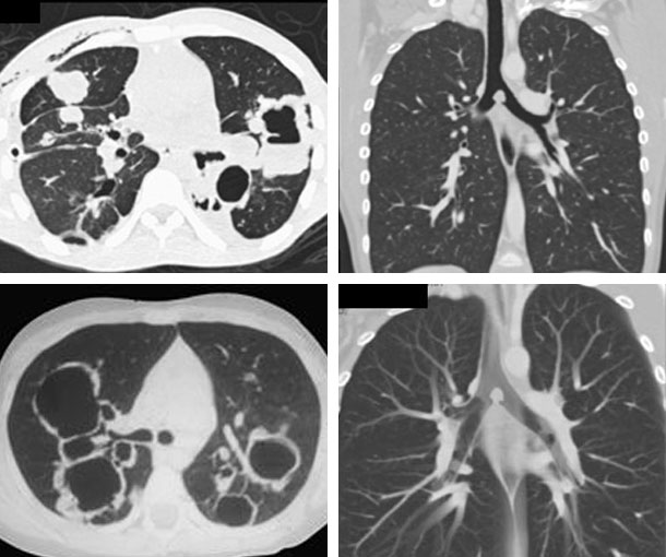 Laryngotracheobronchial Papillomatosis CT Findings