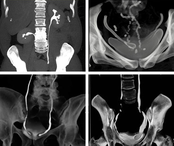 Ureterocele CT Findings