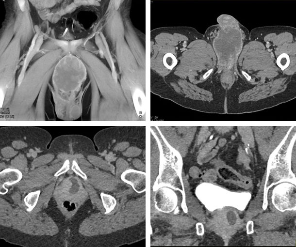 Urethral Carcinoma CT Findings