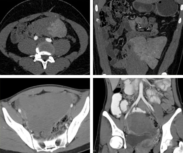 Wandering Spleen CT Appearance