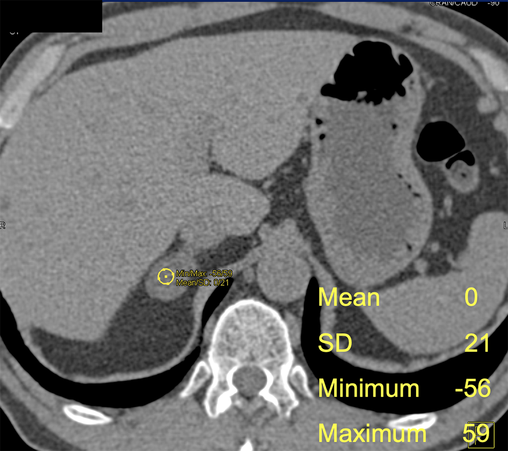 CT of the Adrenal Mass