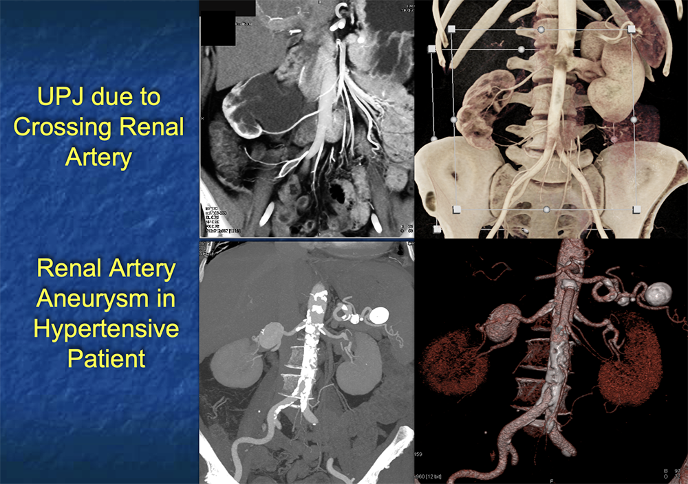 CT of the Aorta and its Branches
