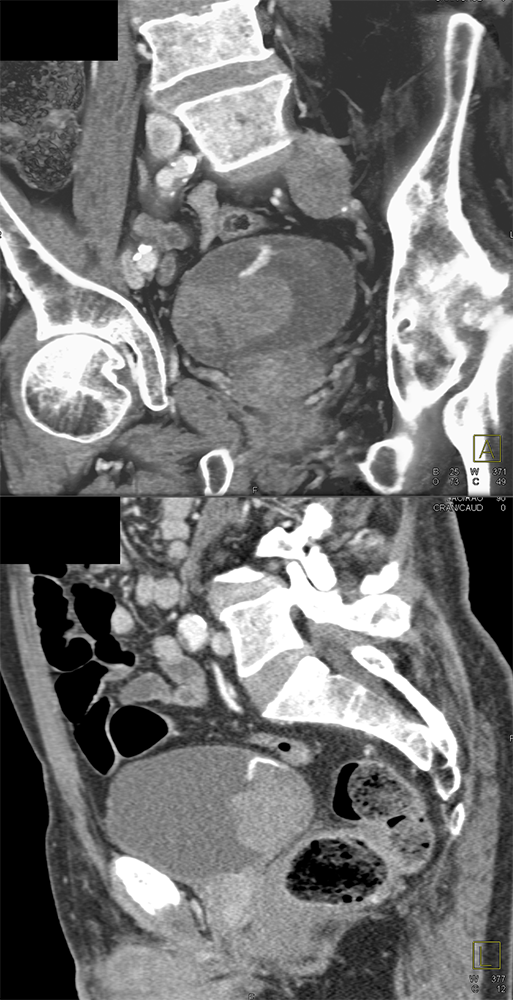 CT of the Bladder
