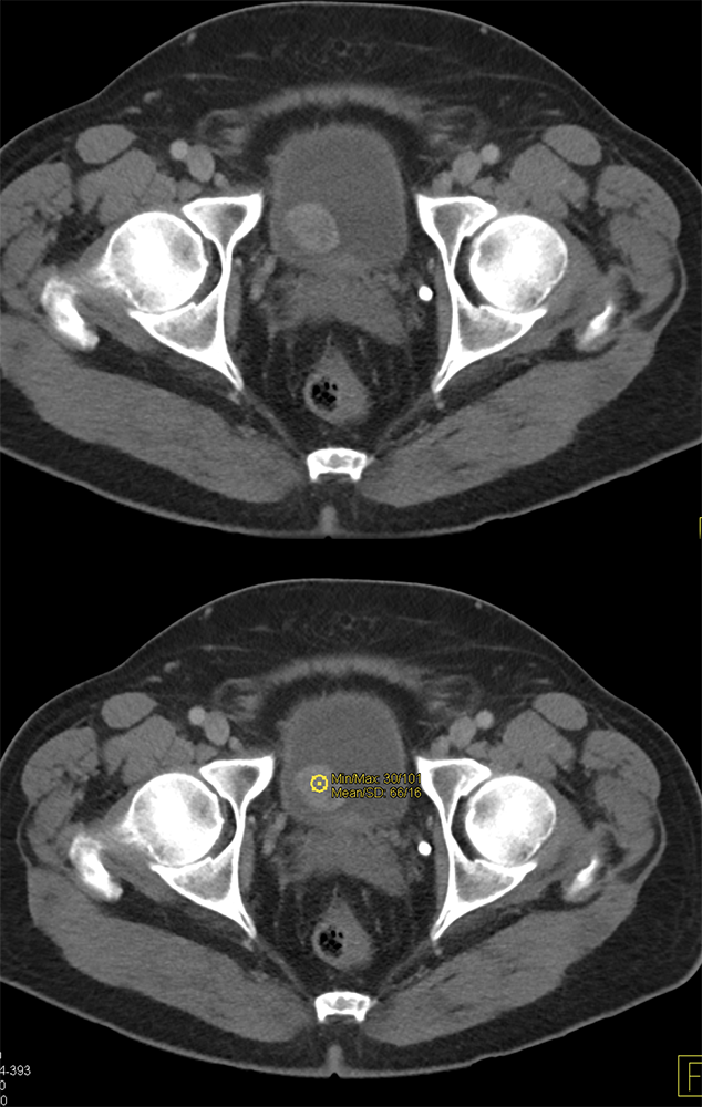 CT of the Bladder