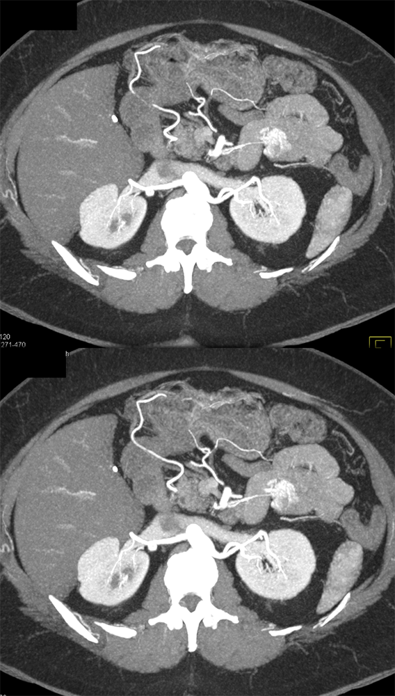 CT of GI Bleed