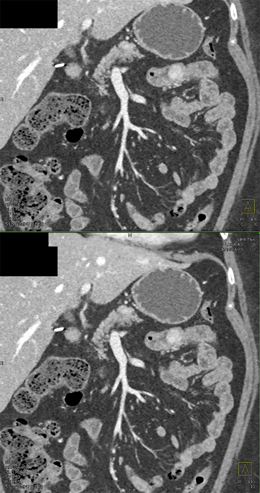 CT of GI Bleed