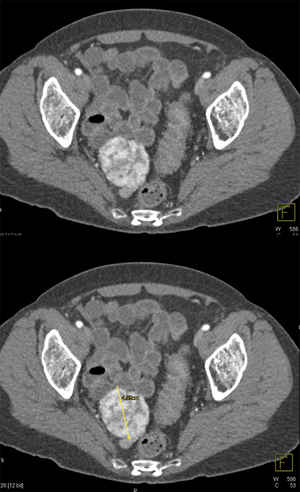 GI Bleed with Leiomyoma Ileum with Negative Capsule Study