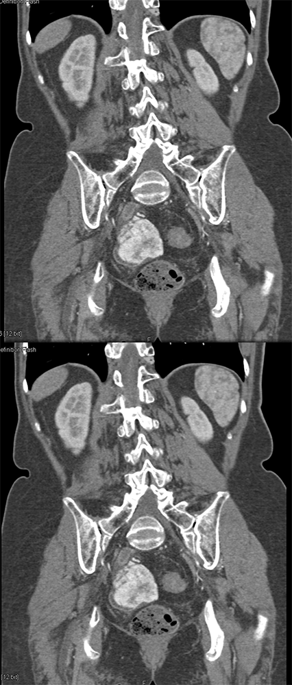 CT of GI Bleed