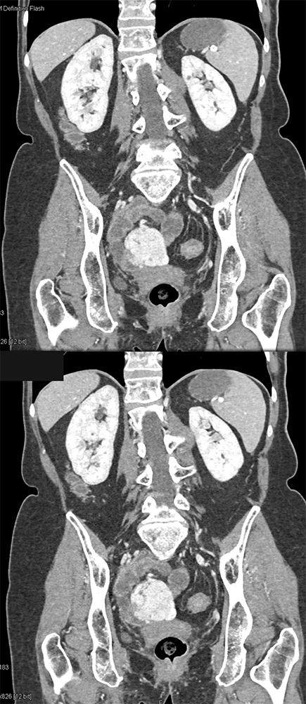 CT of GI Bleed