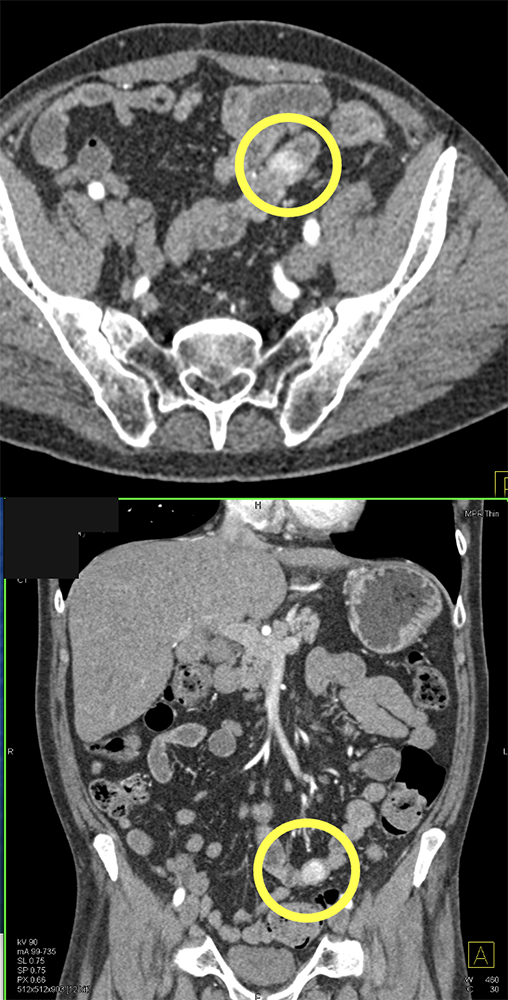 RCC Metastatic to Small Bowel