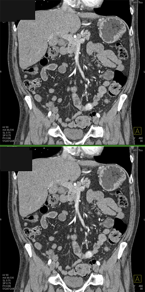 CT of GI Bleed