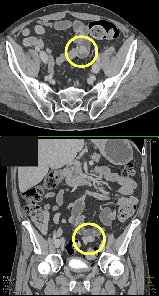 CT of GI Bleed