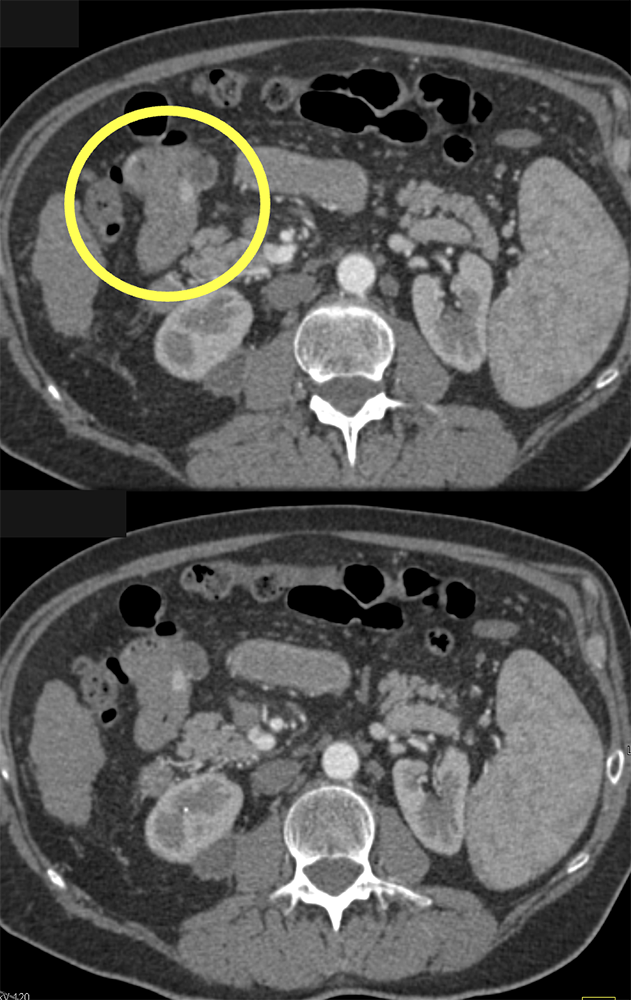 Vascular Foci in Duodenum: Angiodysplasia