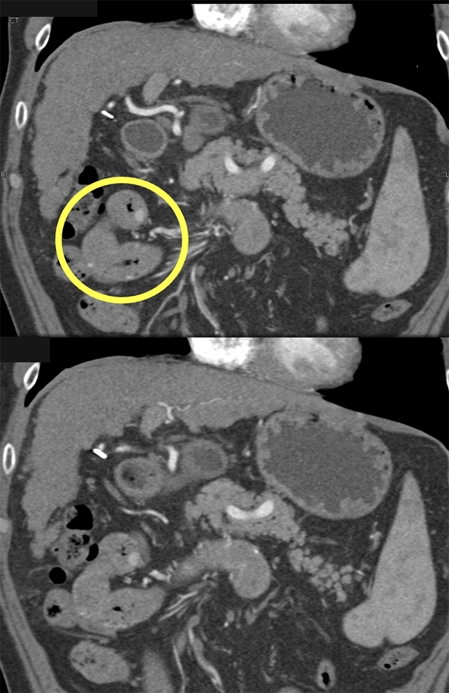 CT of GI Bleed