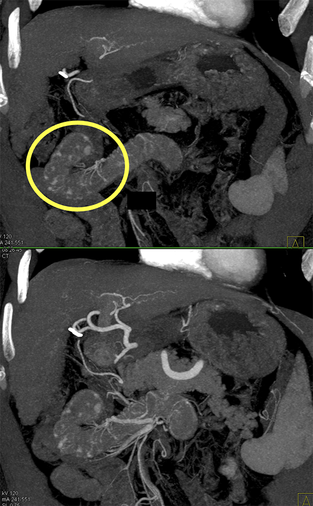 CT of GI Bleed