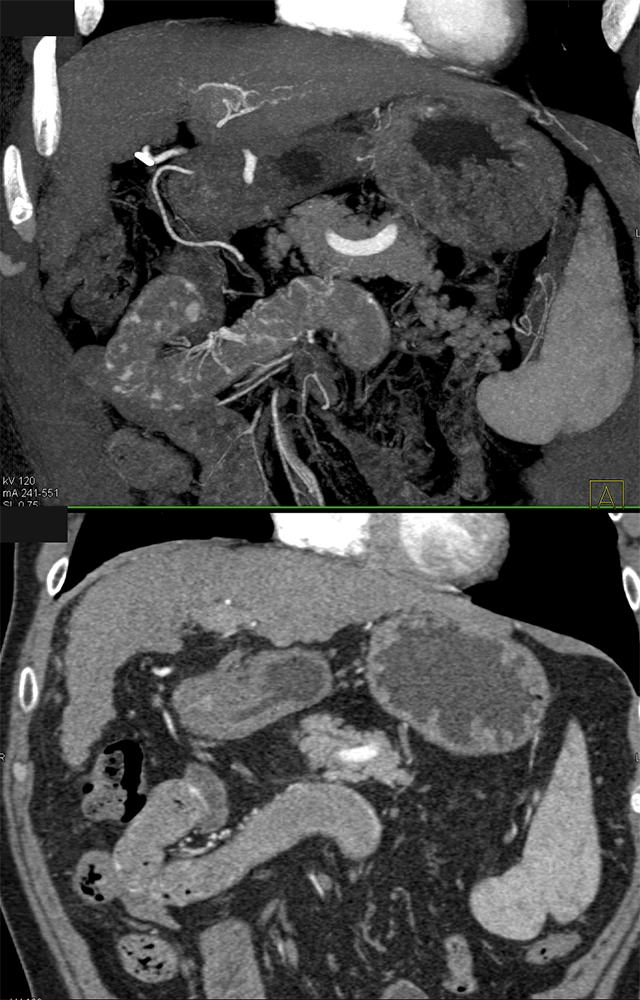 CT of GI Bleed