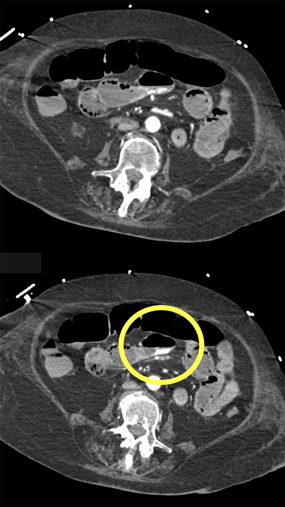 Bleeding Ulcer Small Bowel in Patient with Polymyositis and ILD (Bleed increases Art-Venous)