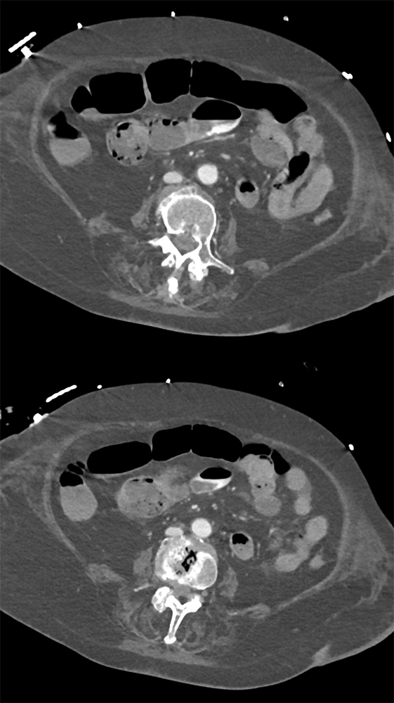CT of GI Bleed