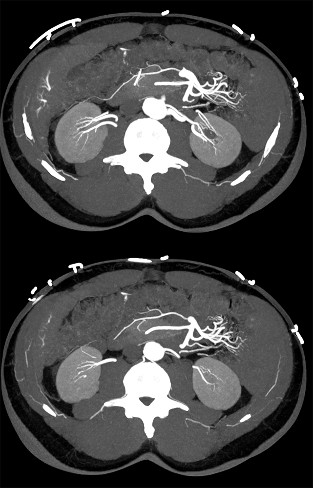CT of GI Bleed