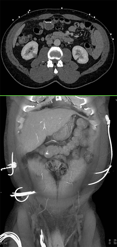 CT of GI Bleed