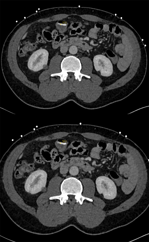 CT of GI Bleed