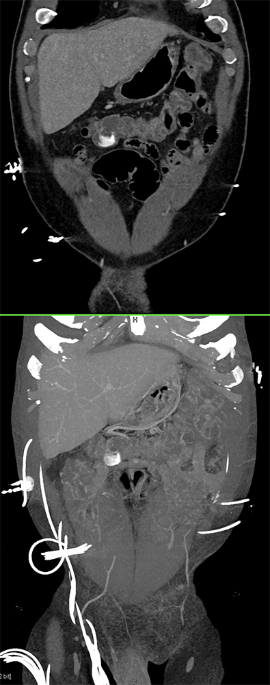 CT of GI Bleed