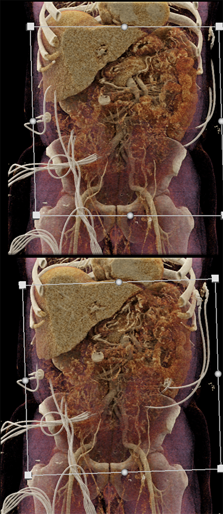 CT of GI Bleed