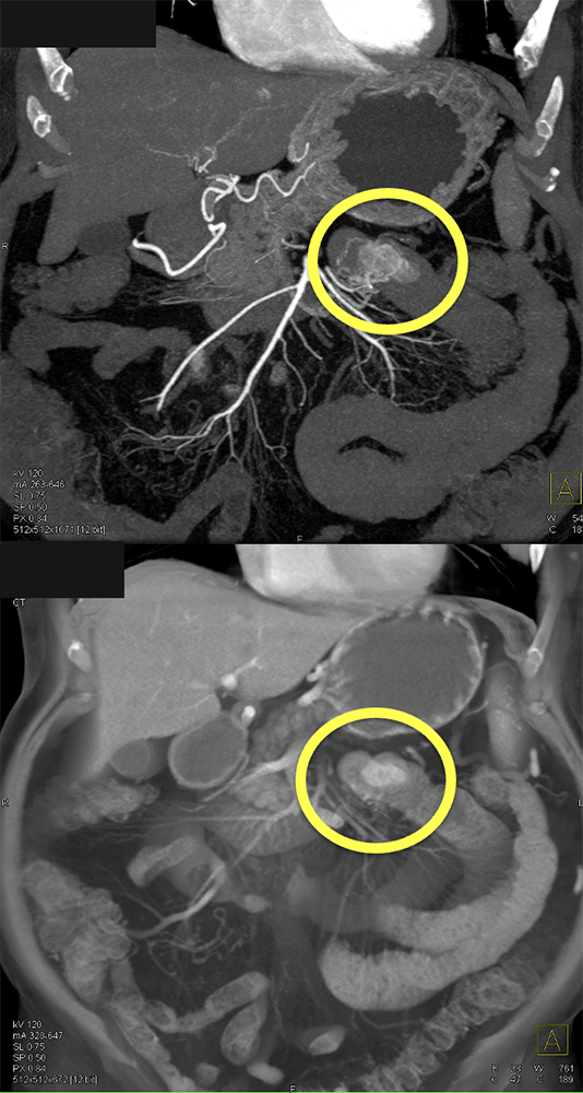 GIST Tumor Jejunum as the Cause of GI Bleeding
