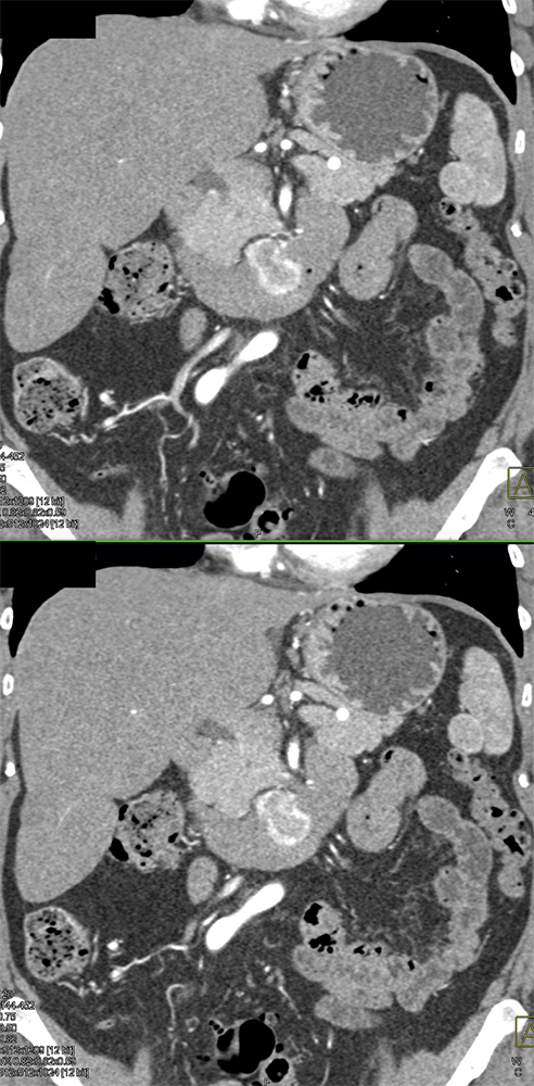 CT of GI Bleed