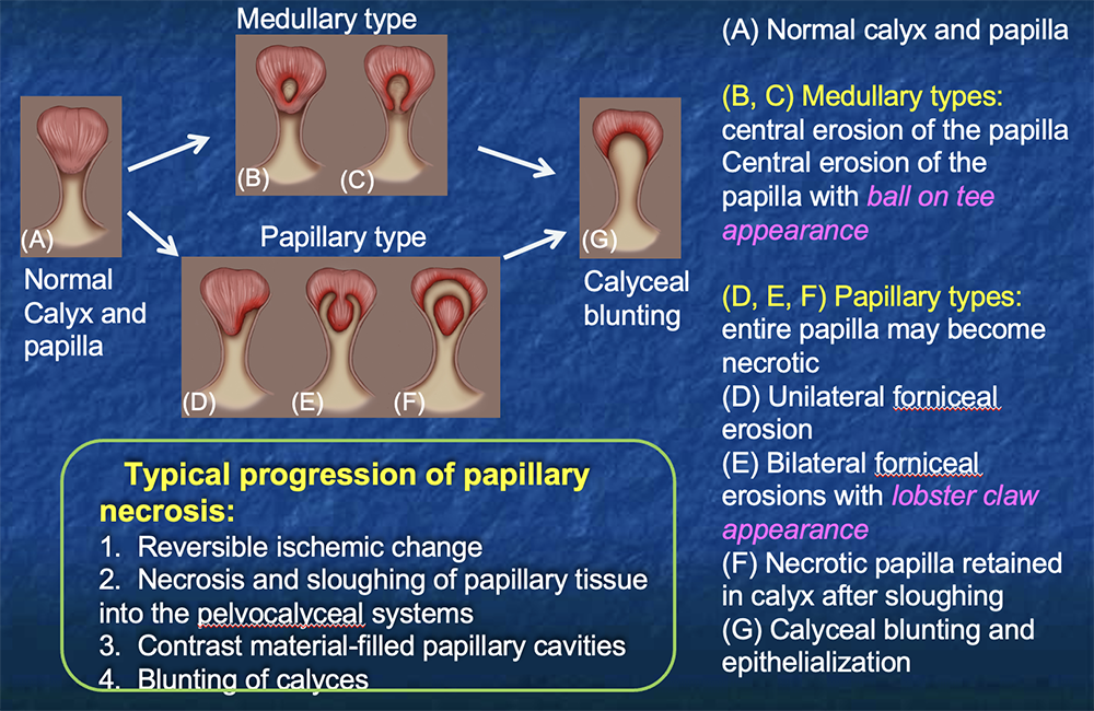 Papillary Necrosis