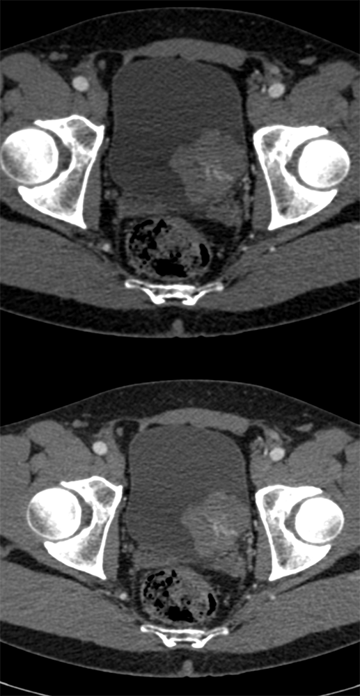 Bladder Cancer