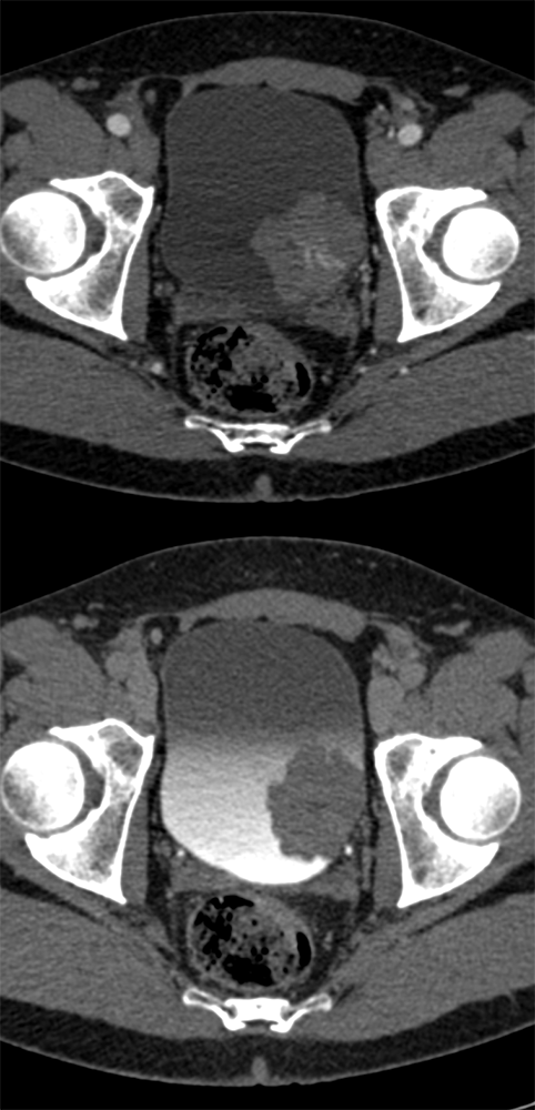 CT of Hematuria