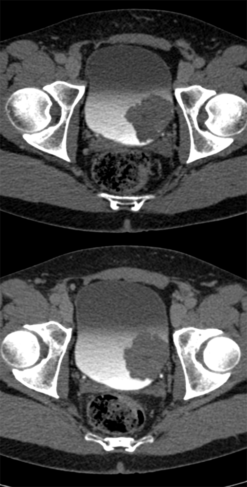 CT of Hematuria