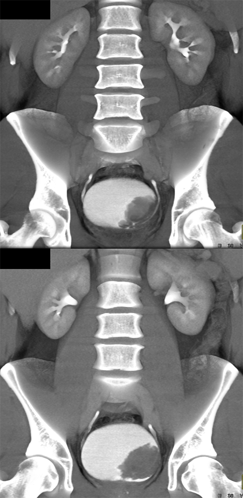 CT of Hematuria